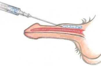 Een gevaarlijke methode voor penisvergroting met behulp van vaseline-injecties